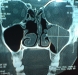 12-nasal-antral-polyps