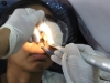 16-co2-laser-for-nasal-allergy