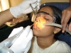 17-co2-laser-for-nasal-allergy005