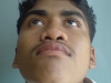 1-pre-op-rhinoplasty