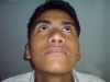 2-post-op-rhinoplasty