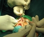 rhinoplasty3