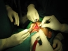 rhinoplasty6
