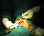 rhinoplasty7