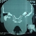 ct-aural-atresia