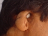 microtia2