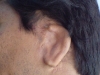 microtia5