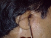 microtia6