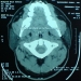 ct-pn-ratio1