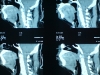 ct-pn-ratio4