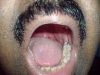 malampati4