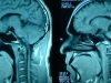 mri-snorer