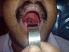 snorer-blue-uvula3