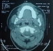 velopharyngeal-airway-in-osa