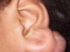 14-keloid-ear-lobe