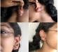15-keloid01