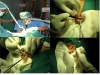 16-laser-excision-keloid
