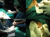 17-laser-surgery-removing-keloid