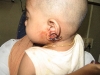 20-torn-ear-lobe