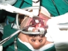 laser-surgery-for-osa