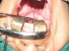 antrochoanal-polyp