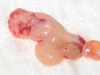 antrochoanal-polyp4