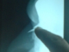 fracture-nasal-bone1