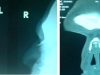 fracture-nasal-bone2