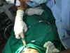 fracture-nasal-bone4