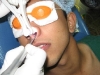 ashish-laser-surgery-nose