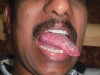 1-ulcer-tongue-web