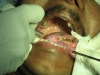 10-laser-ulcer-tongue-web