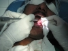 11-laser-ulcer-tongue-web