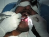 12-laser-ulcer-tongue-web