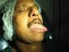 1ulcer-tongue-web