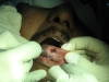 5-laser-ulcer-tongue-web