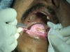 7-laser-luekoplakia-tongue-web