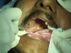 9-laser-ulcer-tongue-web