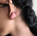 1-keloid-ear-lobe