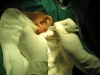 10-laser-excision-keloid