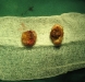11laser-excised-keloid