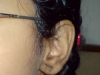 13-keloid-2-months-post-op