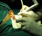 6-laser-keloid