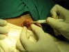 9-injecting-kenacort
