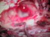 mastoid cavity
