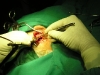 mastoidectomy9