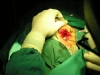 post auricular approach