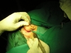incision