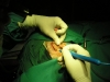 incision2