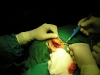 cautery